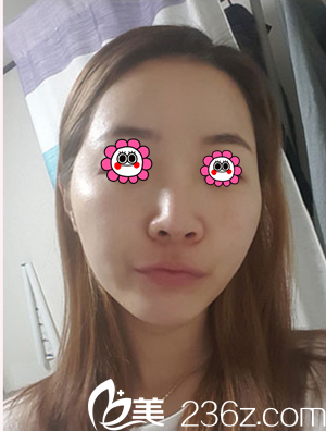 隆鼻前照片 隆鼻前照片