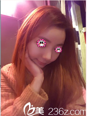 柳济圣给我做隆鼻后手术一个月了 柳济圣给我做隆鼻后手术一个月了