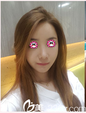 隆鼻两个月后<span style= 隆鼻两个月后<span style=