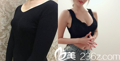北京集美名媛脂肪丰胸案例对比照