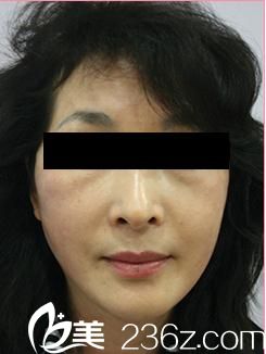 看日本有名的整形医生中北信昭在自由之丘整形外科医院为我做的奇迹线雕面部提升术