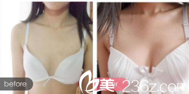 北京亚馨美莱坞自体脂肪丰胸优惠活动进行中！自体脂肪隆胸9800元起