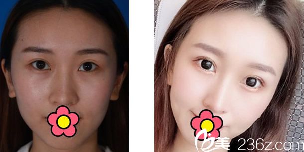 伊思整形医生三眼皮修复+自体软骨隆鼻效果案例 伊思整形医生三眼皮修复+自体软骨隆鼻效果案例