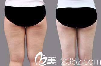 保定华美做双眼皮多少钱?年终整形优惠价只要880元