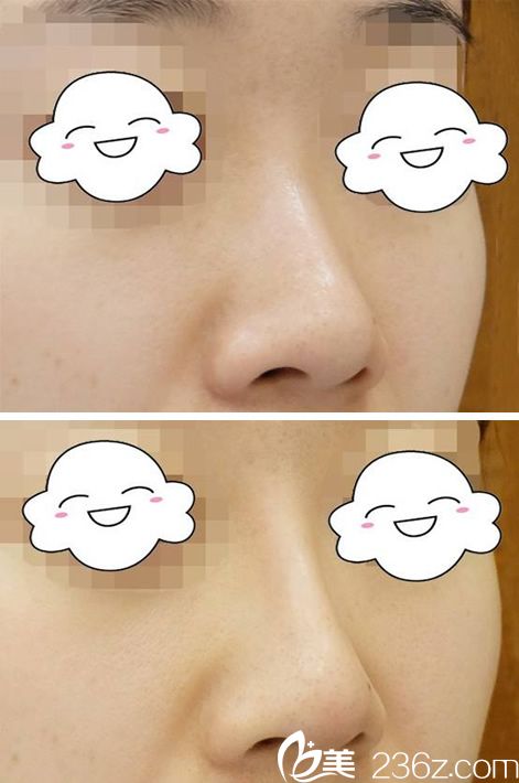 衢州雪荣医院打玻尿酸隆鼻案例 衢州雪荣医院打玻尿酸隆鼻案例