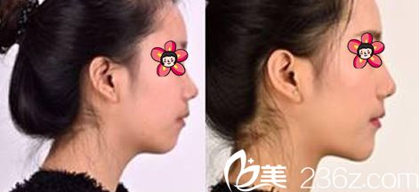 衢州雪荣医院注射玻尿酸丰下巴案例 衢州雪荣医院注射玻尿酸丰下巴案例