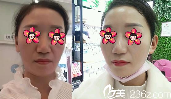 衢州雪荣医院祝少华面部线雕案例 衢州雪荣医院祝少华面部线雕案例