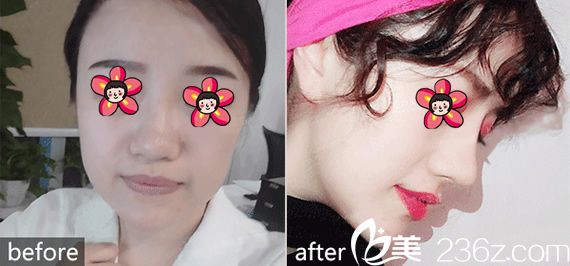 <!--<i data=20240703-sp></i>-->整形医院隆鼻案例 <!--<i data=20240703-sp></i>-->整形医院隆鼻案例