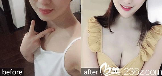 <!--<i data=20240703-sp></i>-->整形医院隆胸案例 <!--<i data=20240703-sp></i>-->整形医院隆胸案例