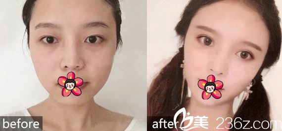 <!--<i data=20240703-sp></i>-->整形医院双眼皮案例 <!--<i data=20240703-sp></i>-->整形医院双眼皮案例