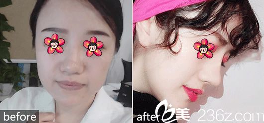 整形冯利光鼻综合案例