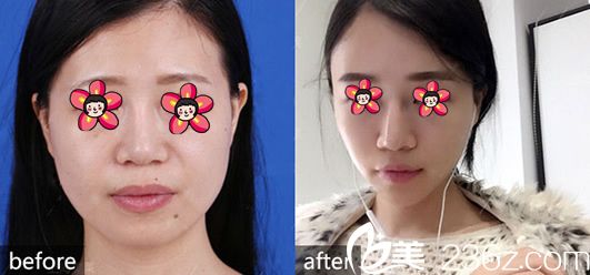 谢剑自体脂肪填充案例