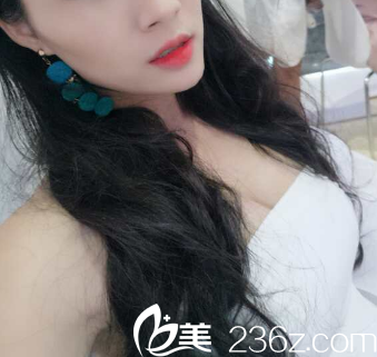 广州艺美做自体脂肪隆胸怎么样