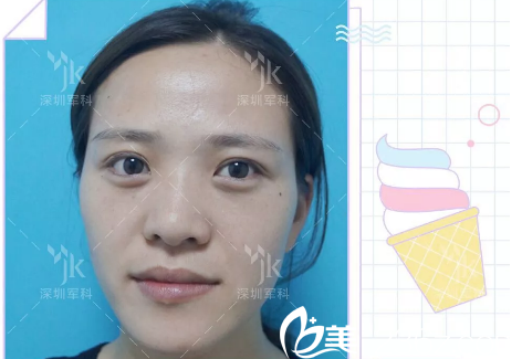 脂肪填充术前照片 脂肪填充术前照片