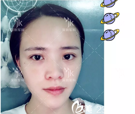 自体脂肪填充术后7天效果 自体脂肪填充术后7天效果