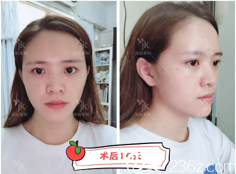 刘月更自体脂肪填充15天效果 刘月更自体脂肪填充15天效果