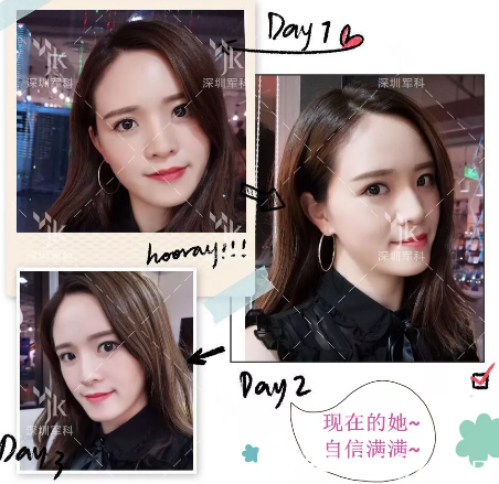 对比了深圳军科和阳光整形医院的案例后找刘月更做了自体脂肪全脸填充