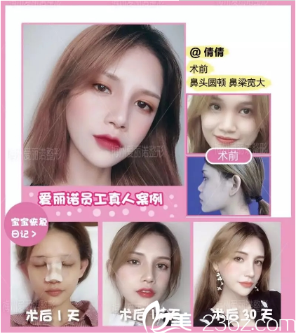 梅州爱丽诺隆鼻案例 梅州爱丽诺隆鼻案例