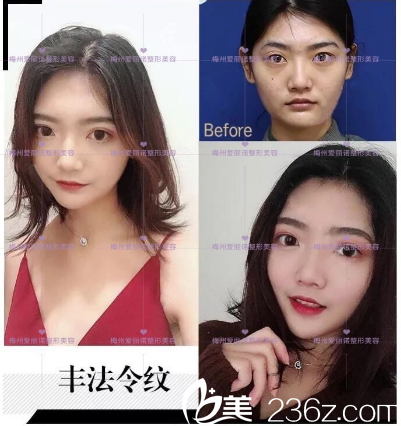 梅州爱丽诺玻尿酸面部填充案例 梅州爱丽诺玻尿酸面部填充案例