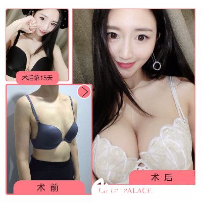 梅州爱丽诺医疗美容医院隆胸案例 梅州爱丽诺医疗美容医院隆胸案例