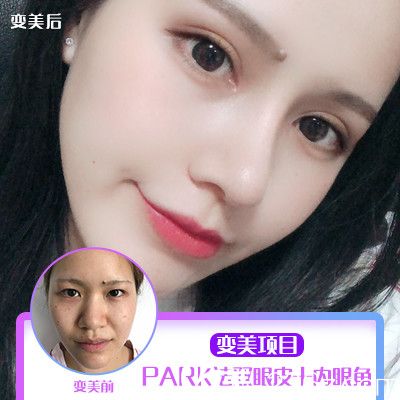 梅州爱丽诺双眼皮隆鼻案例 梅州爱丽诺双眼皮隆鼻案例