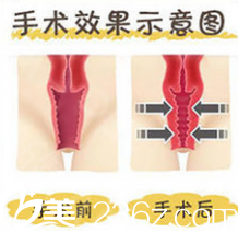 北京玲珑梵宫手术缩阴道多少钱？私密整形特惠价格表来参考