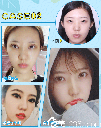 广州曙光范丹的双眼皮案例 广州曙光范丹的双眼皮案例