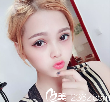 广州曙光范丹做双眼皮怎么样