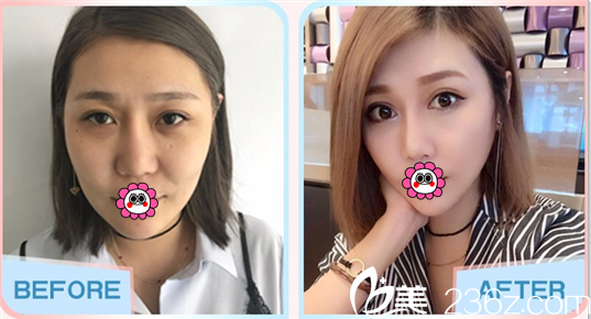 北京当代医院割双眼皮多少钱？全切双眼皮3200元起附案例