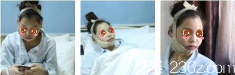 韩国女神整形医院金镇亨下颌角磨骨真人案例术后第三天