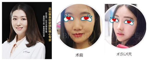 看成都米兰柏羽隆鼻好吗 看成都米兰柏羽隆鼻好吗