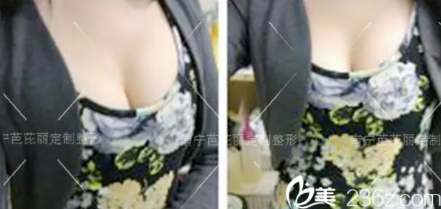 美女老师选择在南宁芭芘丽做了自体脂肪丰胸术后罩杯从A升到C