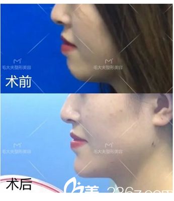 洛阳毛大夫乔雅登玻尿酸填充下巴案例