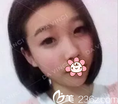 双眼皮开眼角术前照片 双眼皮开眼角术前照片