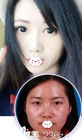 淮北相山时光刘家贺双眼皮案例效果对比图