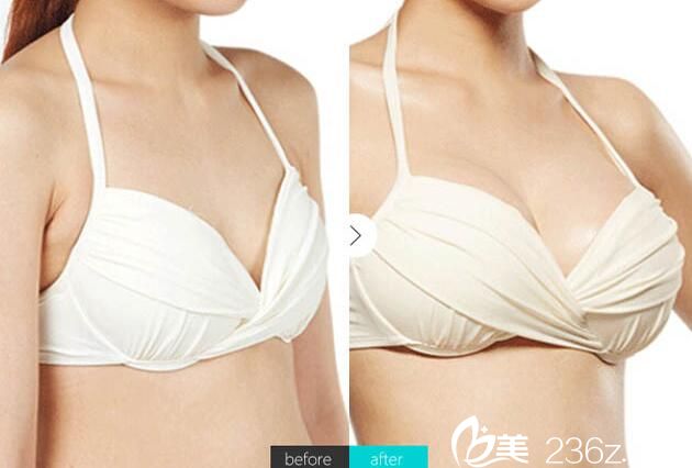 淮北相山时光王锋院长假体隆胸案例效果对比图