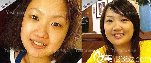 在温州yestar做眼睛鼻子和牙齿前 在温州yestar做眼睛鼻子和牙齿前