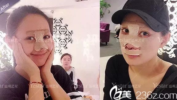 刚做完眼睛和鼻子手术照片 刚做完眼睛和鼻子手术照片