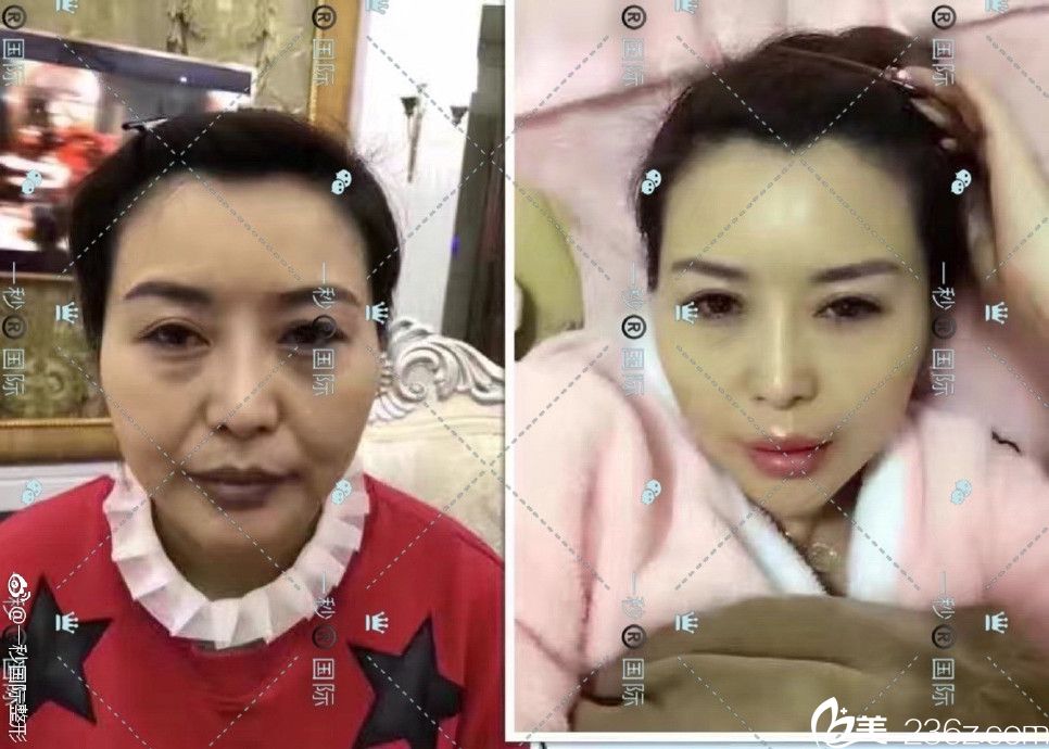 正规的是多少钱？跨年芜湖一秒整形不限部位价格仅需2980元