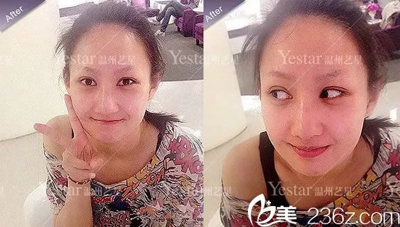 做完双眼皮和隆鼻5天拆线<span style= 做完双眼皮和隆鼻5天拆线<span style=