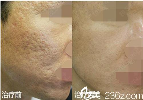 韩国BLS医院祛痘印案例对比图 韩国BLS医院祛痘印案例对比图
