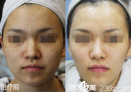 韩国BLS整形外科医院祛色素对比图 韩国BLS整形外科医院祛色素对比图