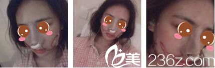 上海复美医疗美容门诊部于晓萍鼻综合真人案例术后第二天