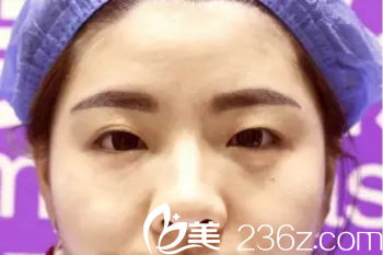 做显微精雕电眼术术前照 做显微精雕电眼术术前照