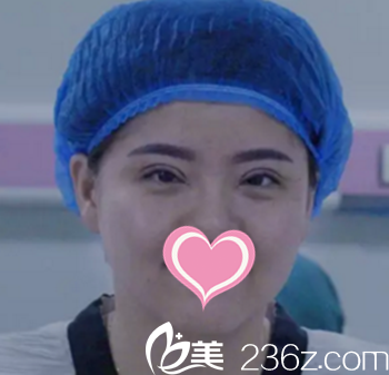 双眼皮术后即刻效果展示 双眼皮术后即刻效果展示