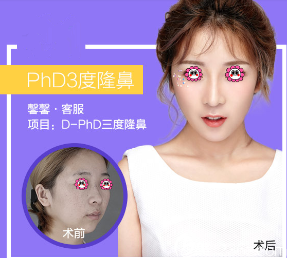 北京米兰柏羽丽都吴玉家假体隆鼻