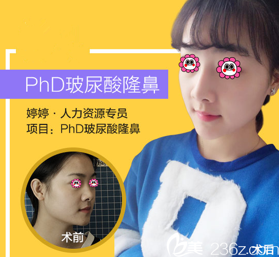 北京米兰柏羽丽都曹令玻尿酸隆鼻