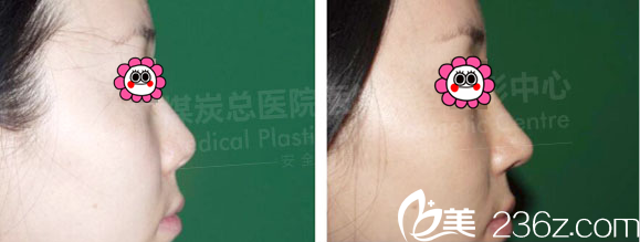 <!--<i data=20240703-sp></i>-->李敏硅胶假体隆鼻