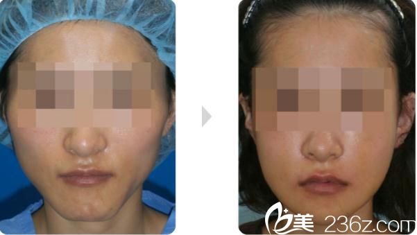 下颌骨削骨前后对比