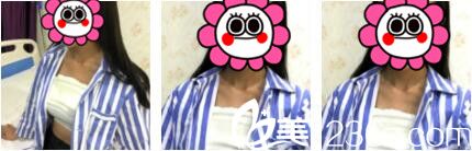 上海复美医疗美容门诊部于晓萍自体脂肪隆胸真人案例术后第三天